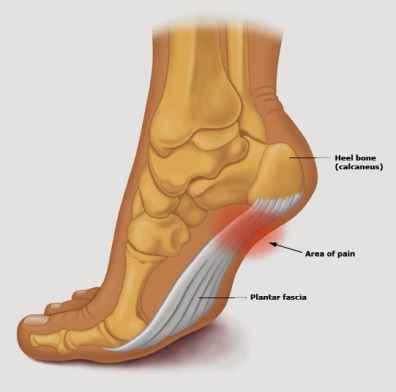 Plantar Fasciitis